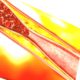 atherosclerosis-antique