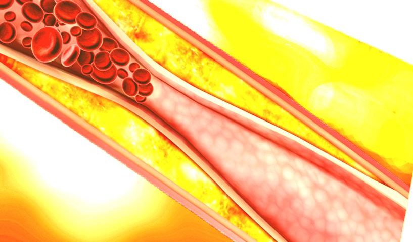 atherosclerosis-antique