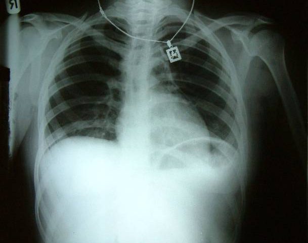 pneumo1